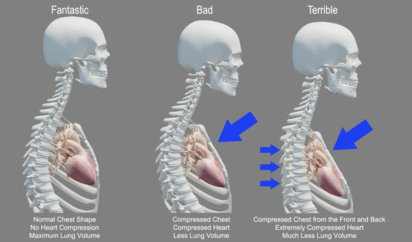 Recent research shows how bad posture increases your rate of mortality. 