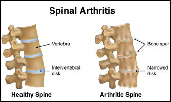 Chiropractic and Arthritis 
